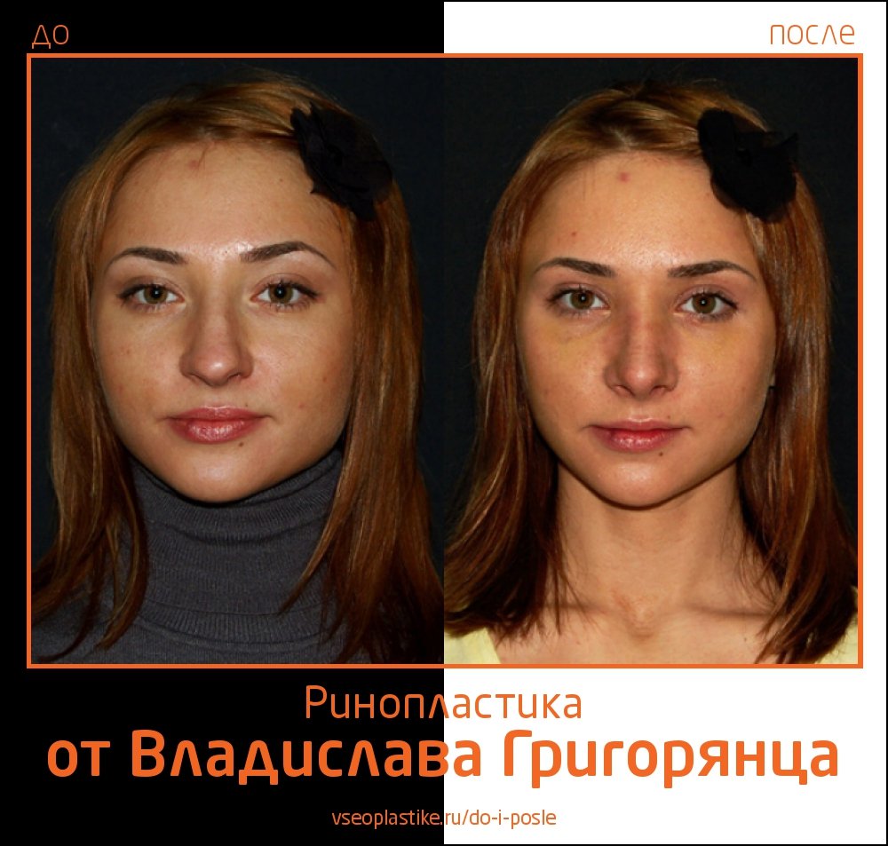 До и после ринопластики у Воладислава Григорянца