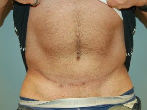 Абдоминопластика у мужчин