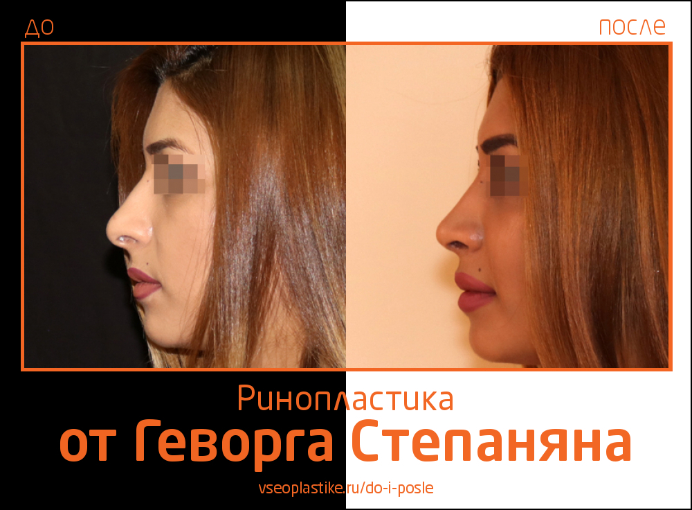 Геворг Степанян. Фото до и после ринопластики
