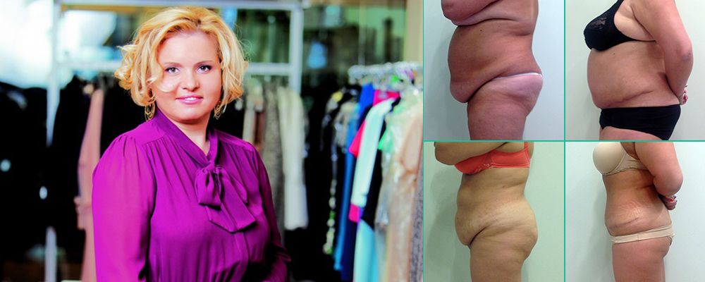 Светлана Пшонкина лучший хирург по абдоминопластике