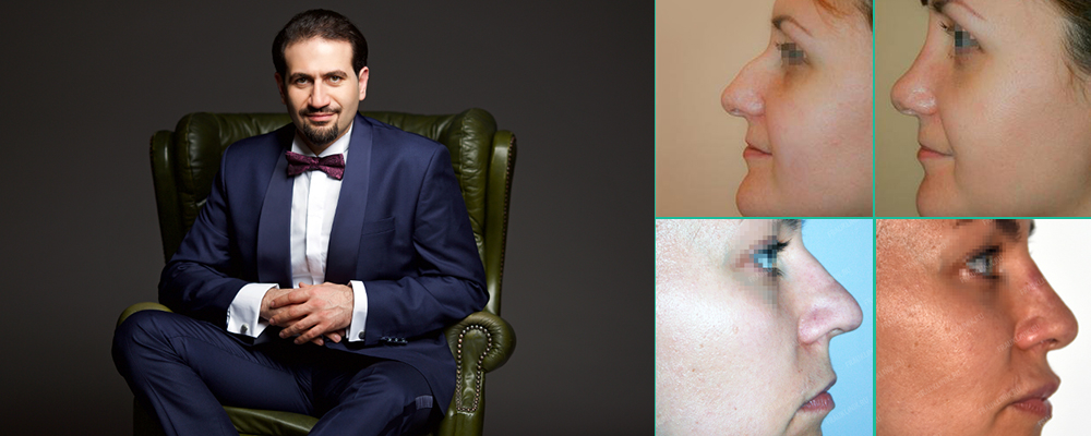 Соломон Абрамян микроринопластика лучший хирург