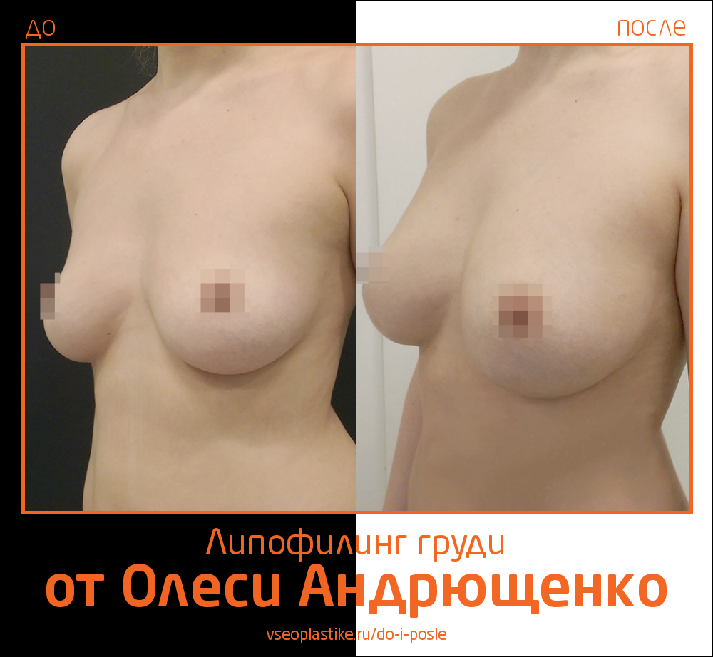 Фото до и после липофилинга груди у пластического хирурга Олеси Андрющенко