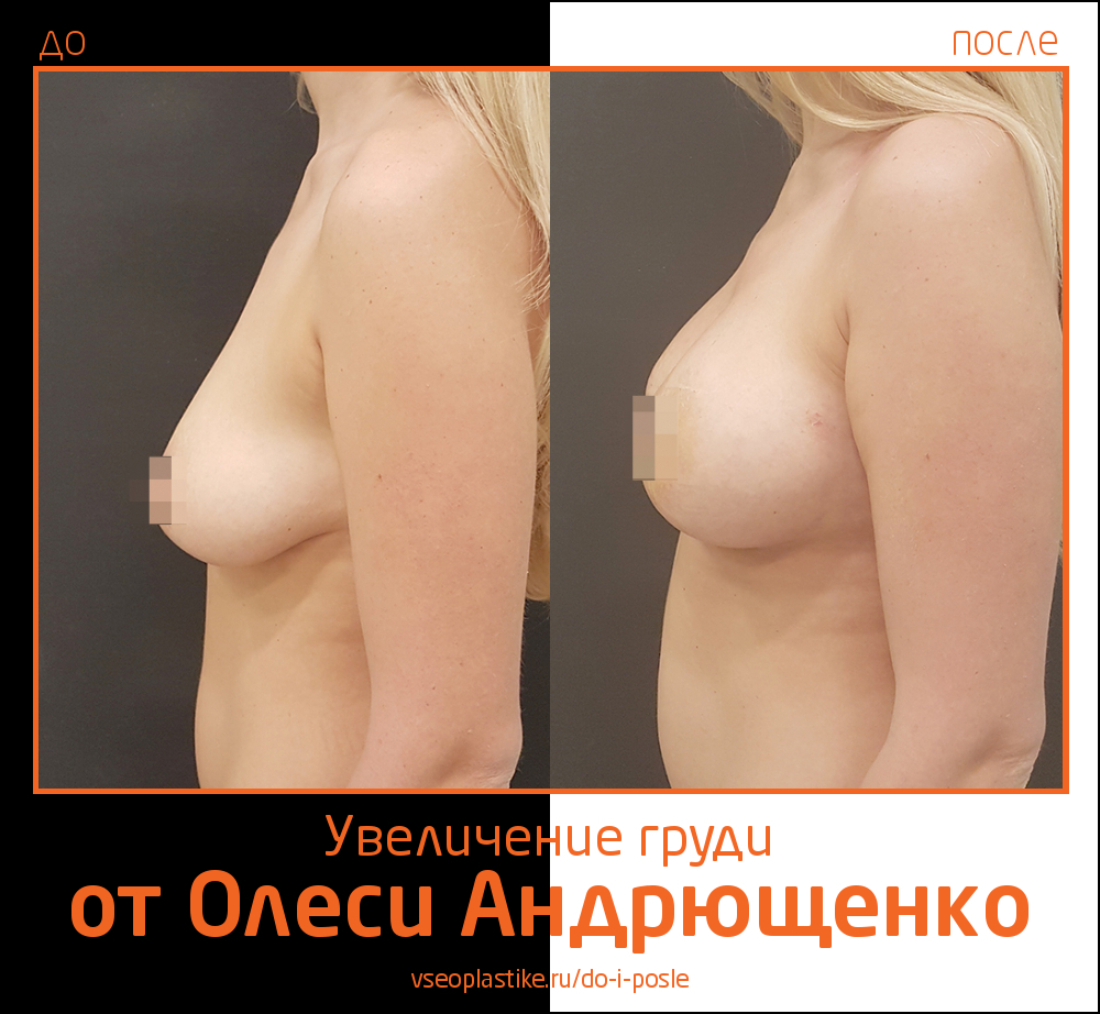 Фото до и после увеличения груди у пластического хирурга Олеси Андрющенко