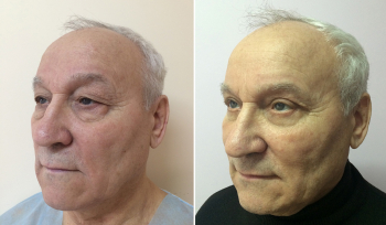 Мужская блефаропластика у пластического хирурга Олеси Андрющенко