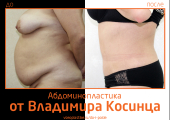Владимир Косинец. Фото до и после абдоминопластики