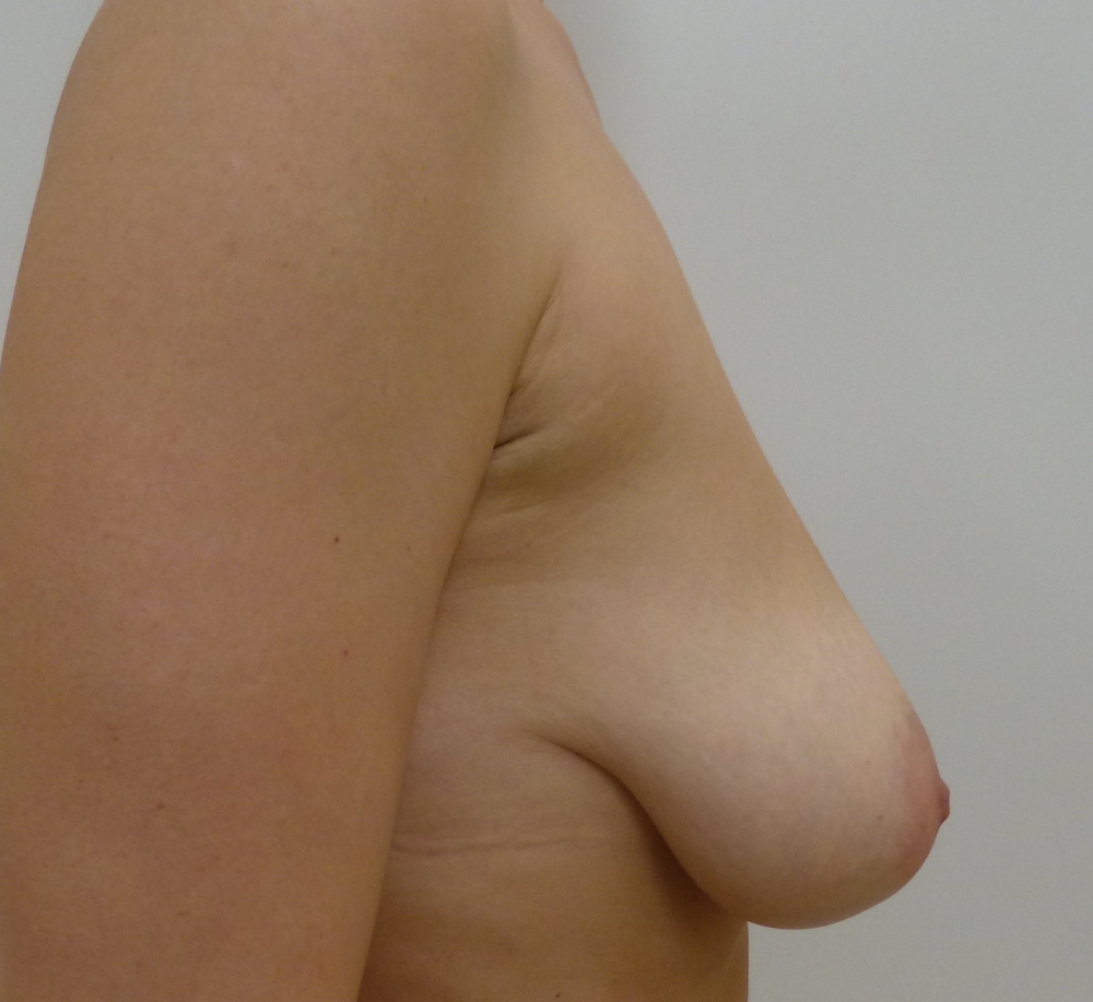 Фотогалерея Коррекция и подтяжка форм груди фото До и После