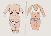 Разновидности абдоминопластики