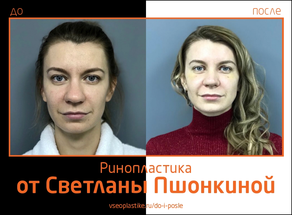 Светлана Пшонкина. Фото до и после ринопластики