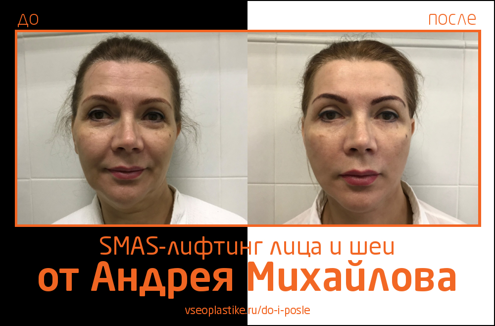 Андрей Михайлов. Фото до и после SMAS-лифтинга лица и шеи