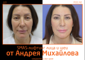 Андрей Михайлов. Фото до и после SMAS-лифтинга лица и шеи