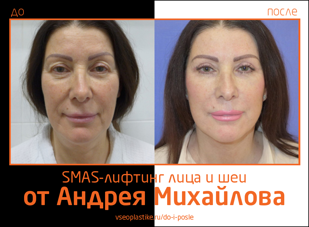 Андрей Михайлов. Фото до и после SMAS-лифтинга лица и шеи