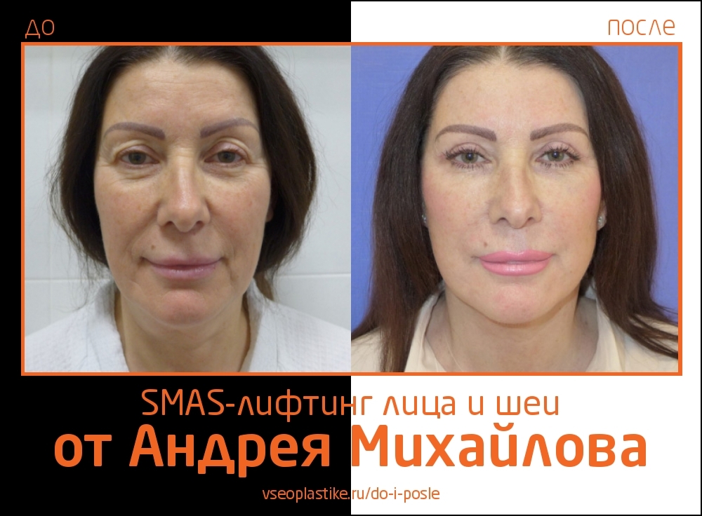 Николай анатольевич до и после пластики