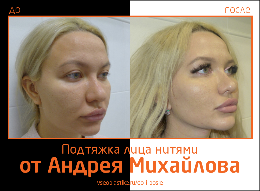 Пациентке была выполнена малоинвазивная подтяжка лица нитями, в результате которой женщина получила естественный эффект омоложения.