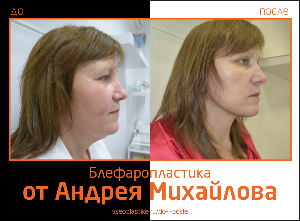 Андрей Михайлов. Фото до и после блефаропластики