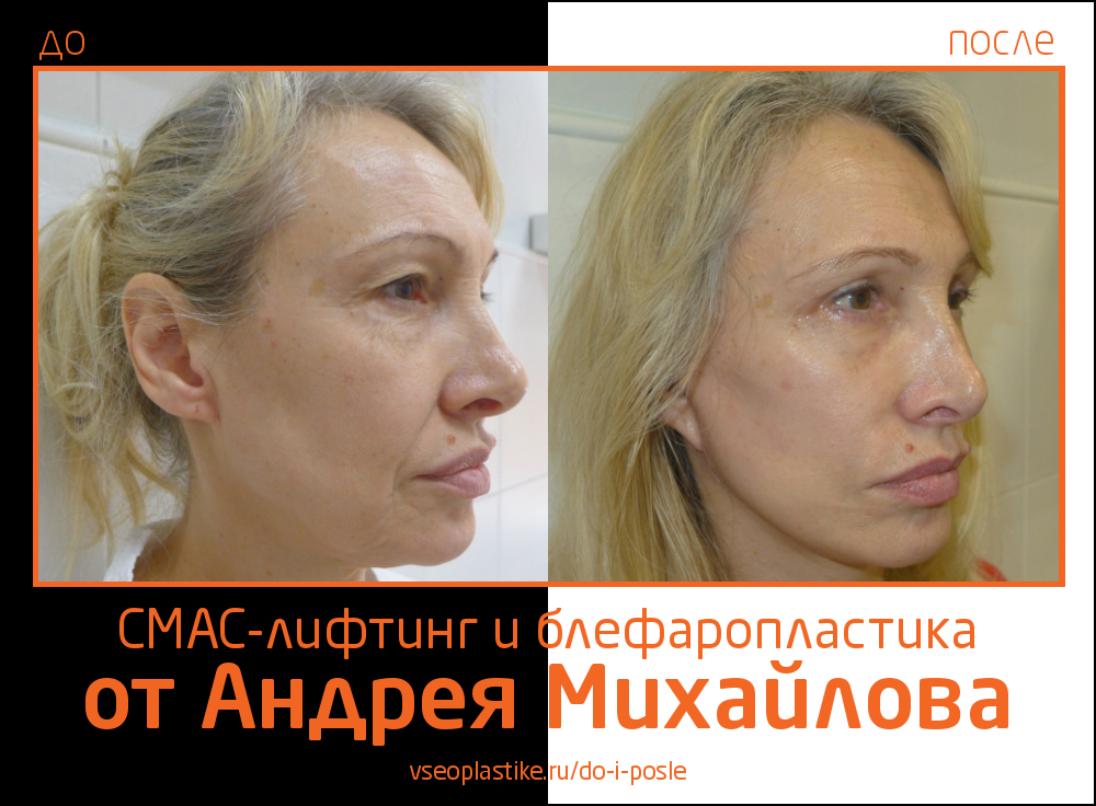 Пациентке была выполнена малоинвазивная подтяжка лица нитями, в результате которой женщина получила естественный эффект омоложения.