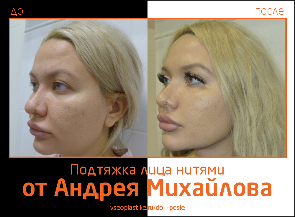 Пациентке была выполнена малоинвазивная подтяжка лица нитями, в результате которой женщина получила естественный эффект омоложения.