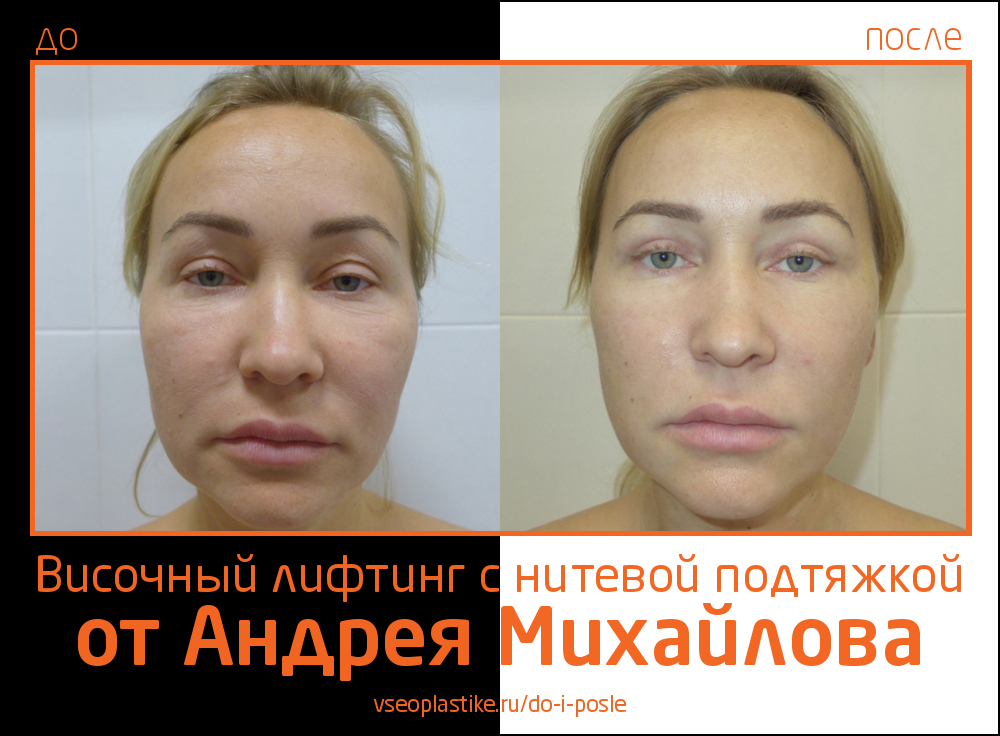 Пациентке был выполнен височный лифтинг и нитевая подтяжка