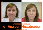 Андрей Михайлов. Фото до и после блефаропластики