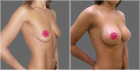 Пшонкина увеличение груди
