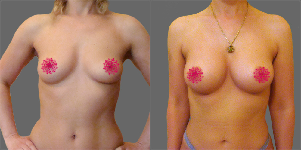 Пшонкина увеличение груди