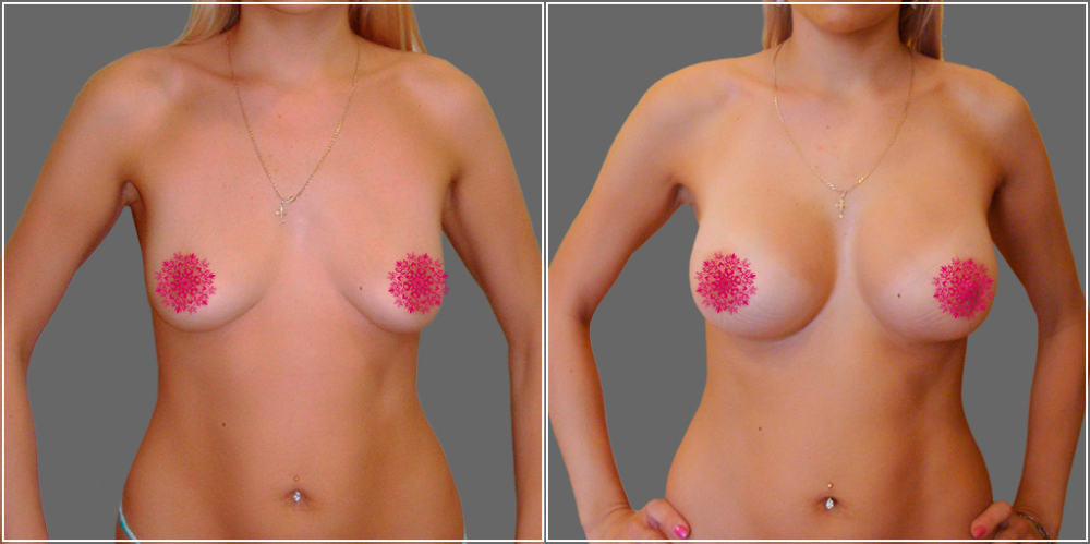 Пшонкина увеличение груди