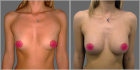 Пшонкина увеличение груди