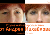 До и после круговой блефаропластики
