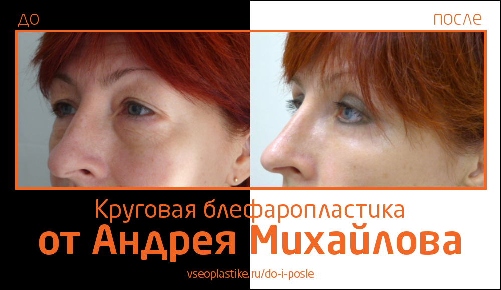 Пациентка после круговой блефаропластики у Андрея Михайлова