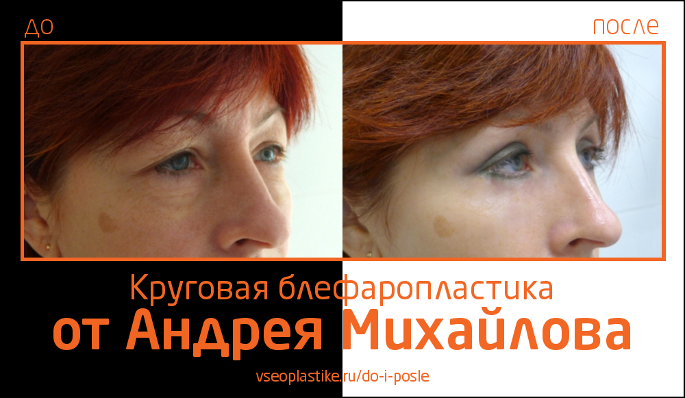 Пациентка после круговой блефаропластики у Андрея Михайлова