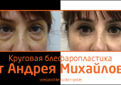 Андрей Михайлов. Фото до и после блефаропластики