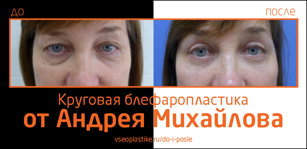 Результат круговой блефаропластики, выполненной Андреем Михайловым
