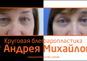 Результат круговой блефаропластики, выполненной Андреем Михайловым