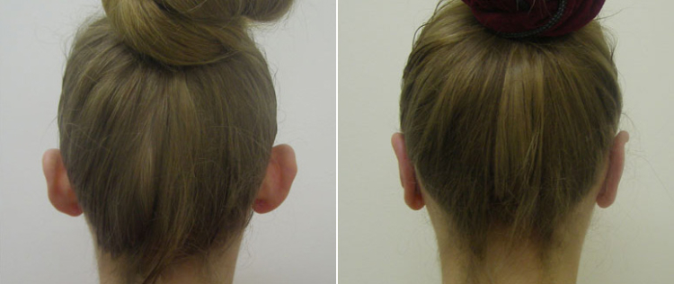 Устранение лопоухости