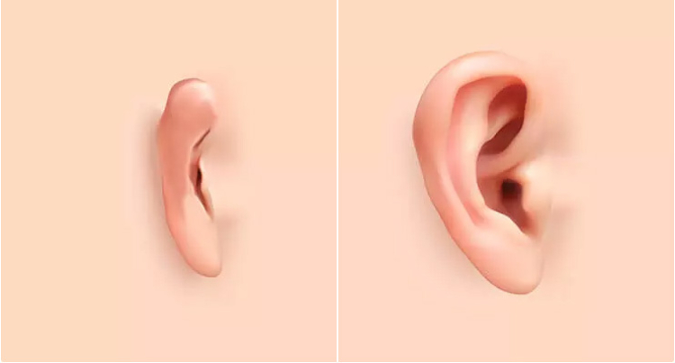 Микротия отопластика