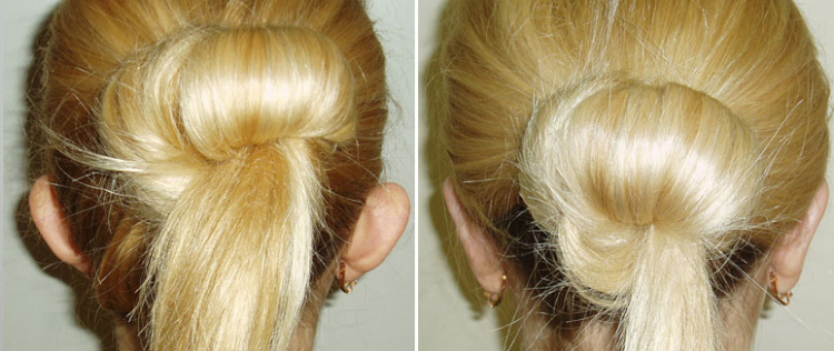 Устранение лопоухости