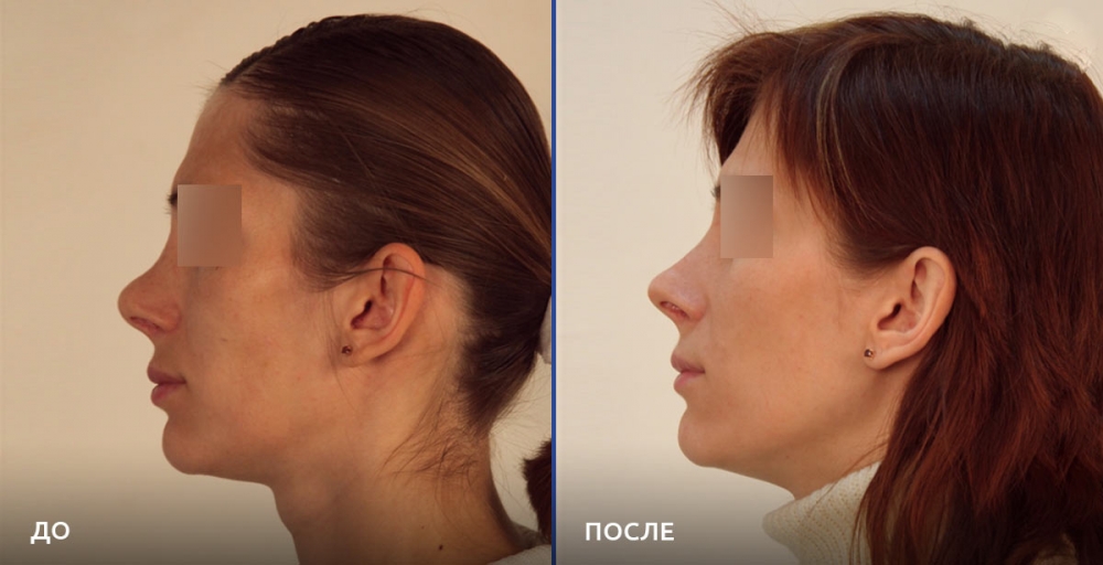 Ринопластика у доктора Евгения Казанцева