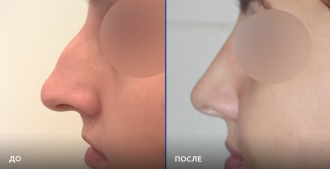 Снимок пациентки до и после ринопластики у доктора Евгения Казанцева
