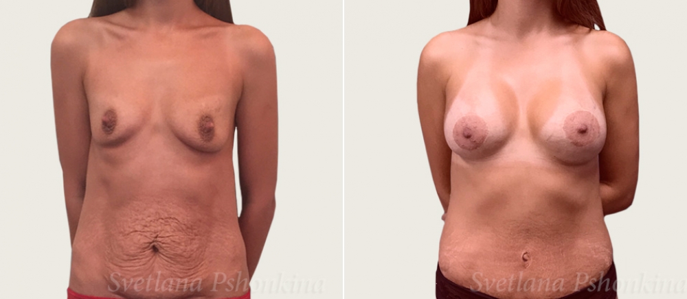 абдоминопластика и увеличение груди Пшонкина