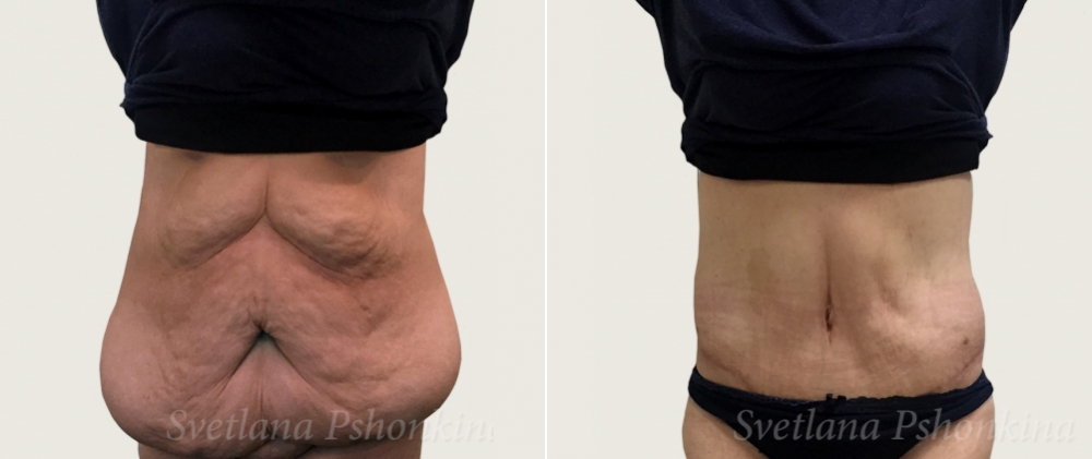 Торсопластика