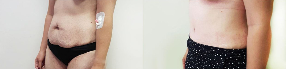 До и после абдлминопластики
