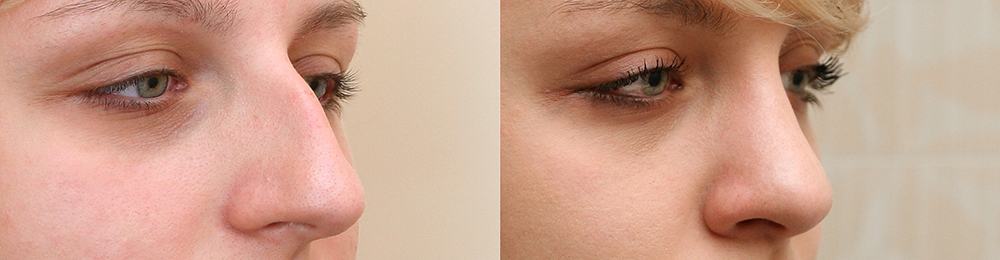 Фото до и после ринопластики у Александра Жукова