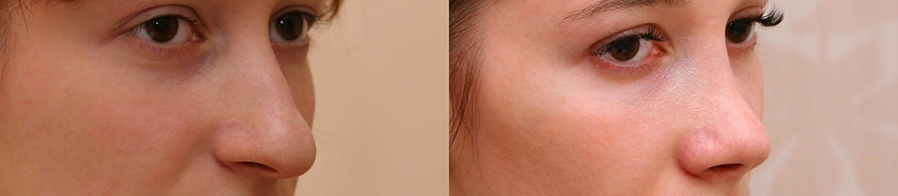 Фото до и после ринопластики у доктора Александра Жукова