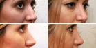 Фото до и после пластики носа у доктора Александра Жукова