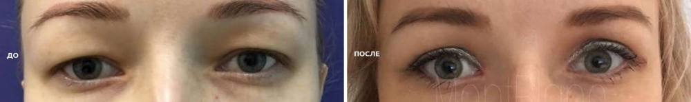 Алексей Гварамия блефаропластика