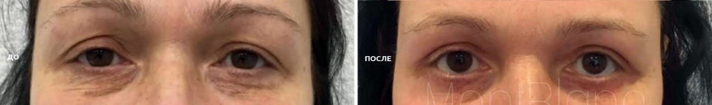 Алексей Гварамия блефаропластика