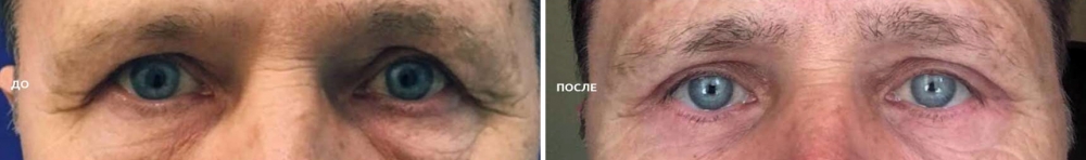 Алексей Гварамия блефаропластика