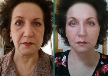 Оксана Кононец омоложение лица