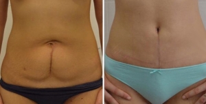 Абдоминопластика Ольга Ованесова