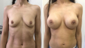 Увеличение груди
