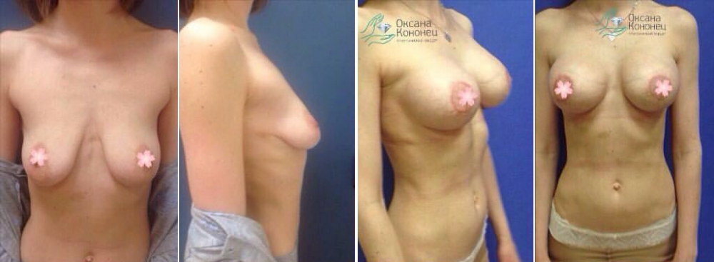 Грудь после родов Оксана Кононец